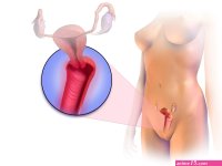 File:Vaginitis.png