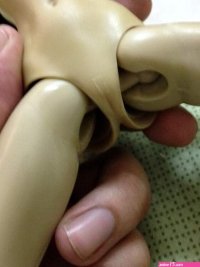 Reversible Pubic Hair Implantation